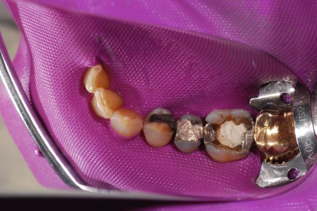 Amalgamfüllung Kofferdam