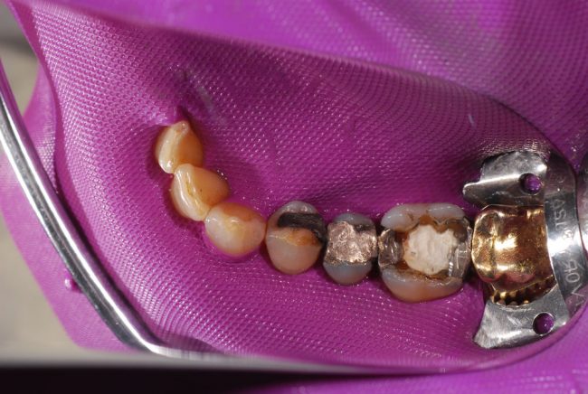 Amalgamfüllung Kofferdam Amalgamfüllung Kofferdam