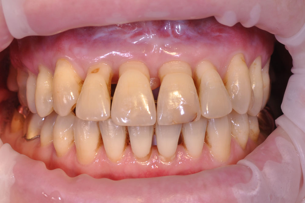 lange Zähne freiliegende Zahnhälse Parodontitis