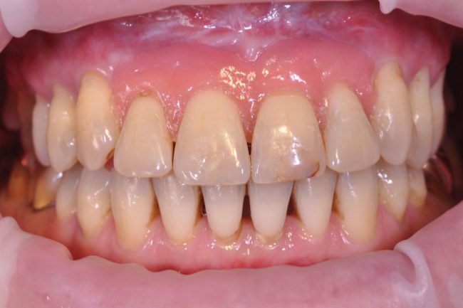 Zahnfleischmaske Parodontitis