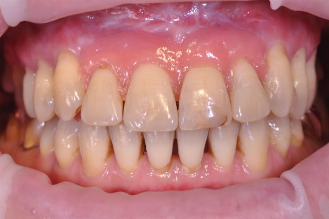 Zahnfleischmaske Parodontitis Zahnfleischmaske Parodontitis