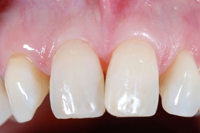 Frontzahnfüllung nach der Behandlung