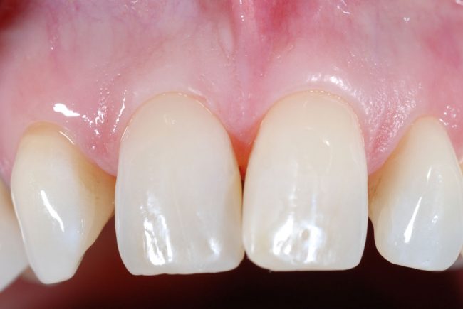 Frontzahnfüllung nach der Behandlung