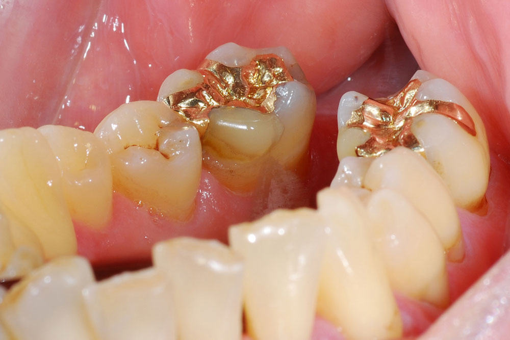 Zahnfüllung mit Gold