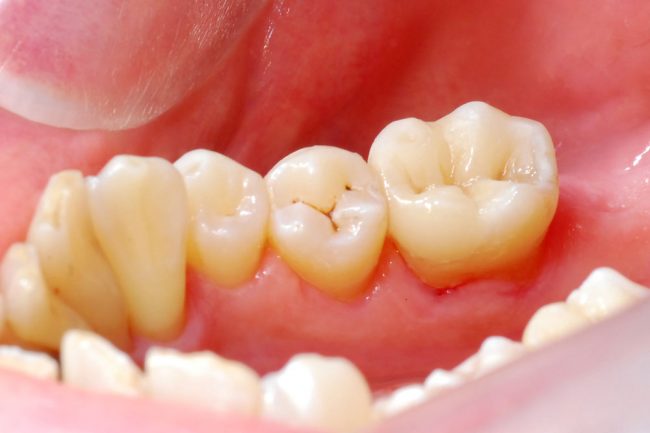 Keramikinlay Keramikteilkrone nach zementieren