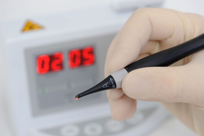 Laser Fissurenversiegelung