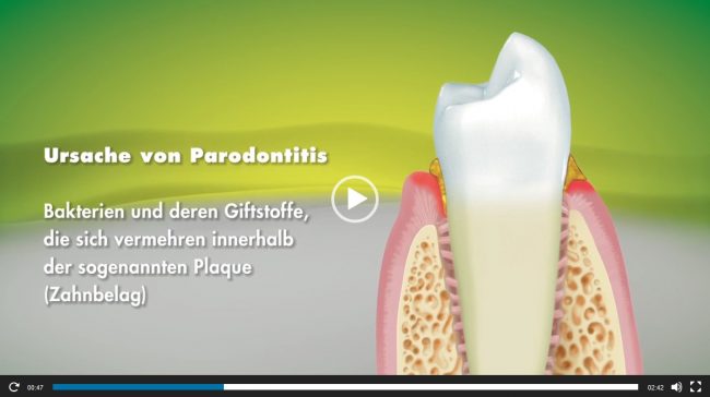 Video Paradontitis Regenerative Parodontologie
