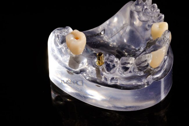 Implantate im Zahnmodell