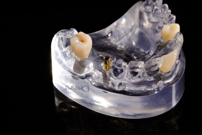 Implantate im Zahnmodell