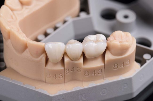 Brücke hochwertige Prothetik