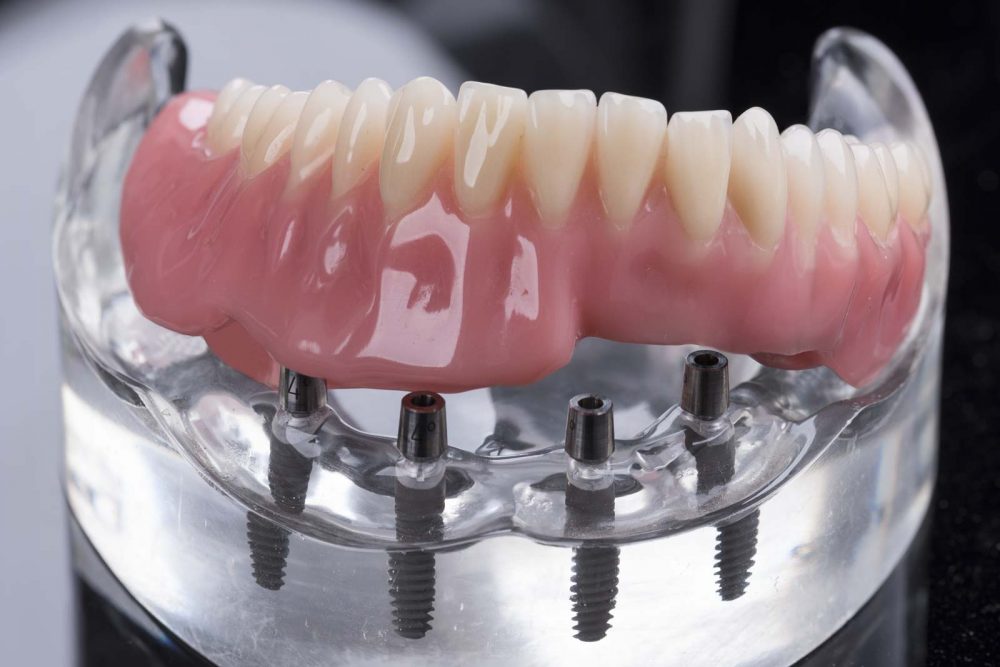 Zahnprothese auf Implantat