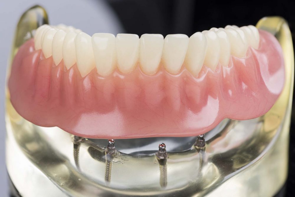 Zahnprothese auf Miniimplantat